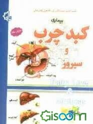 بیماری کبد چرب و سیروز