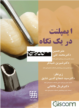 ایمپلنت در یک نگاه